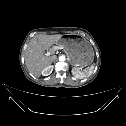 File:Chronic contained rupture of abdominal aortic aneurysm with extensive erosion of the vertebral bodies (Radiopaedia 55450-61901 A 4).jpg