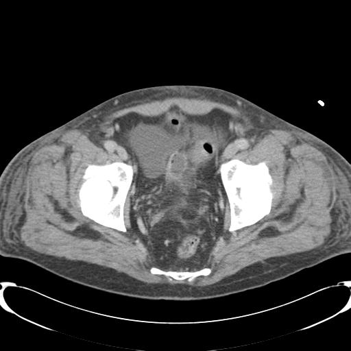 Chronic diverticulitis complicated by hepatic abscess and portal vein thrombosis (Radiopaedia 30301-30938 A 84).jpg
