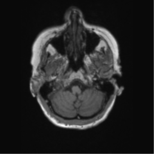 File:Chronic hypertensive encephalopathy (Radiopaedia 72844-83495 Axial T1 62).png