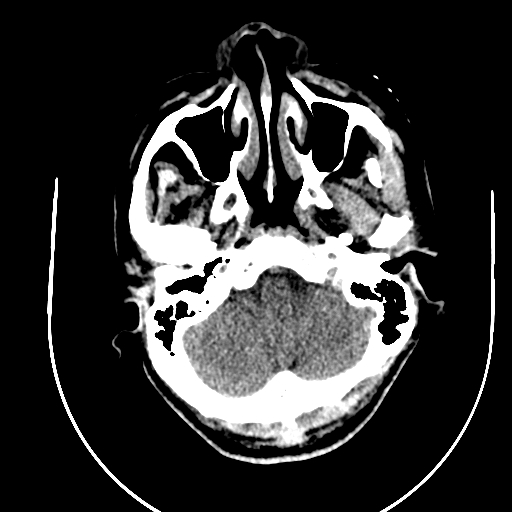 Chronic invasive fungal sinusitis (Radiopaedia 91563-109286 Axial non-contrast 8).jpg