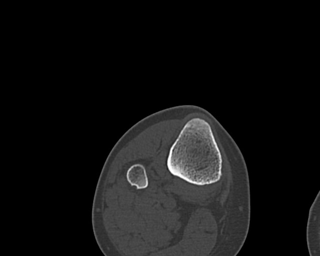 Chronic ostemyelitis of the femur with long sinus tract (Radiopaedia 74947-85982 Axial bone window 253).jpg