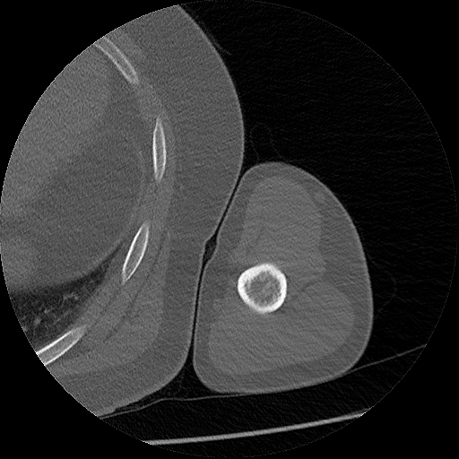 Chronic osteomyelitis (Radiopaedia 67597-76998 Axial bone window 33).jpg