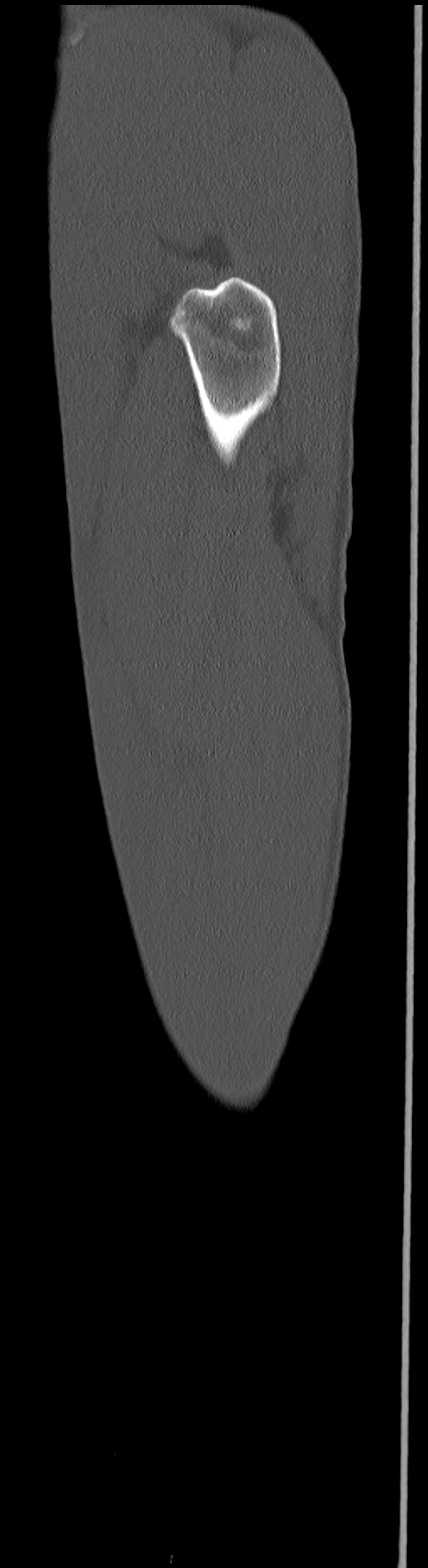 Chronic osteomyelitis (with sequestrum) (Radiopaedia 74813-85822 C 15).jpg
