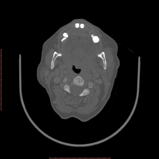 Chronic osteomyelitis - maxilla (Radiopaedia 23783-23927 Axial bone window 52).jpg
