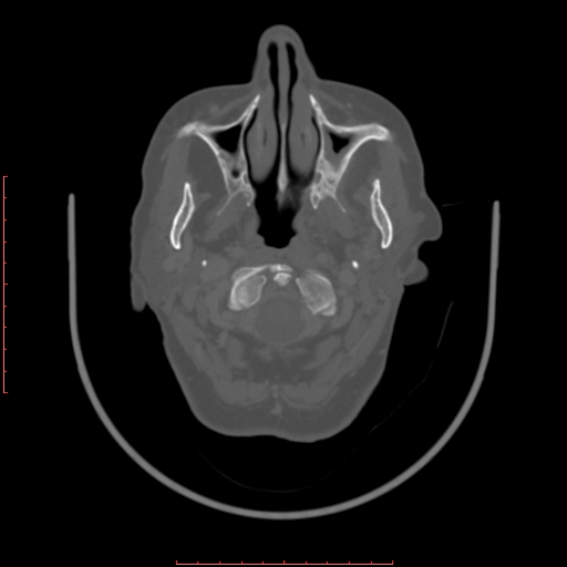 Chronic osteomyelitis - maxilla (Radiopaedia 23783-23927 Axial bone window 96).jpg