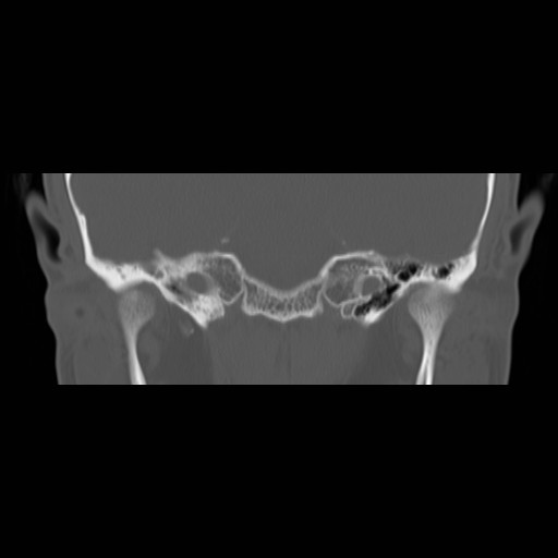 File:Chronic otomastoiditis (Radiopaedia 27138-27309 Coronal bone window 5).jpg