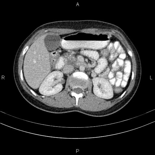 Chronic pancreatitis (Radiopaedia 64576-73450 C 60).jpg