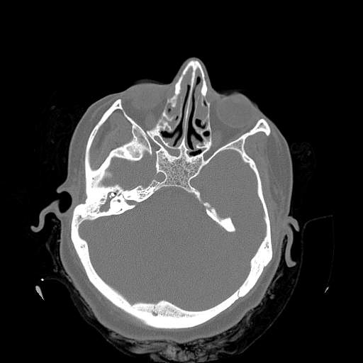 Chronic sinusitis with intra-sinus calcification (Radiopaedia 63919-72668 Axial bone window 24).jpg