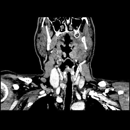 File:Chronic submandibular abscess (Radiopaedia 21738-21718 B 15).jpg