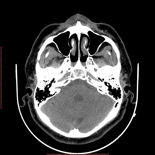 File:Chronic submandibular sialolithiasis (Radiopaedia 69817-79814 Axial non-contrast 2).jpg