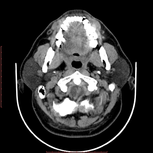 File:Chronic submandibular sialolithiasis (Radiopaedia 69817-79814 Axial non-contrast 57).jpg