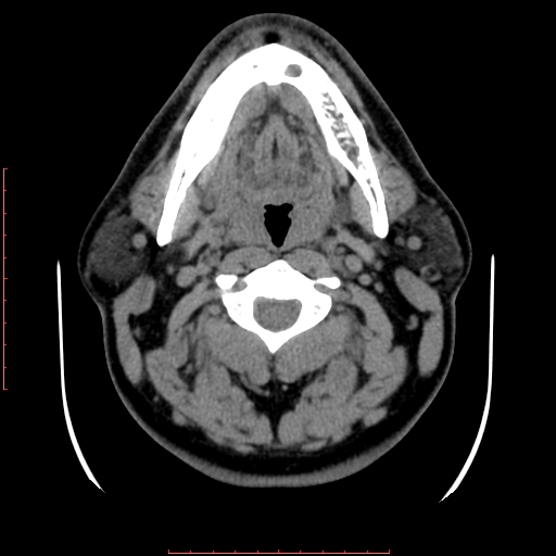 Chronic submandibular sialolithiasis (Radiopaedia 69817-79814 Axial non-contrast 94).jpg
