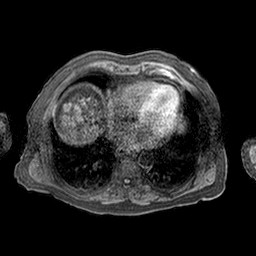 Cirrhosis and hepatocellular carcinoma in the setting of hemochromatosis (Radiopaedia 75394-86594 Axial T1 C+ fat sat 77).jpg