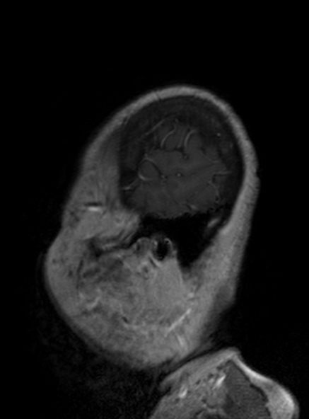 Clival meningioma (Radiopaedia 53278-59248 Sagittal T1 C+ 141).jpg