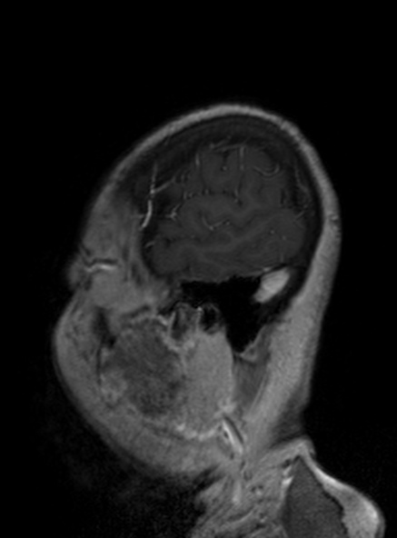 Clival meningioma (Radiopaedia 53278-59248 Sagittal T1 C+ 147).jpg