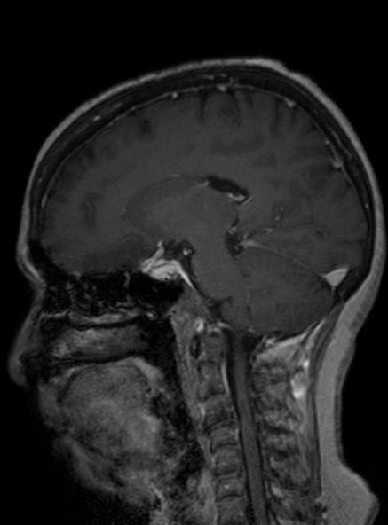 Clival meningioma (Radiopaedia 53278-59248 Sagittal T1 C+ 237).jpg