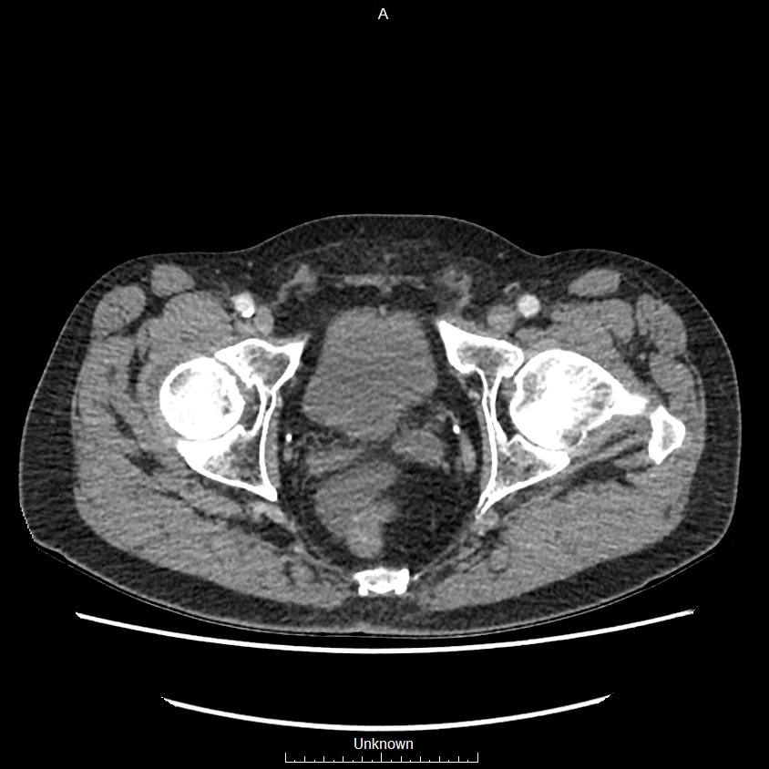 Closed loop bowel obstruction and ischemia (Radiopaedia 86959-103180 A 84).jpg