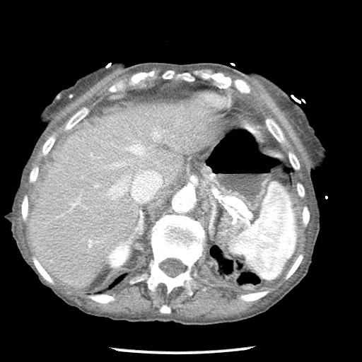 File:Closed loop small bowel obstruction - adhesions and infarct (Radiopaedia 85125-100678 B 18).jpg