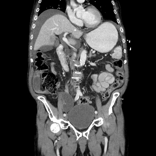 File:Closed loop small bowel obstruction - adhesive disease and hemorrhagic ischemia (Radiopaedia 86831-102990 B 63).jpg