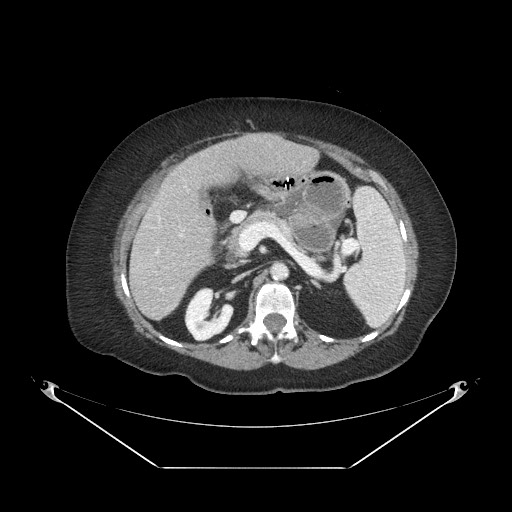 File:Closed loop small bowel obstruction - internal hernia (Radiopaedia 65402-74450 A 39).jpg