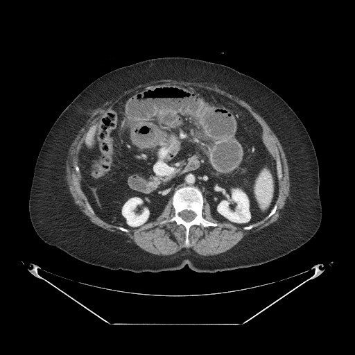Closed loop small bowel obstruction - internal hernia (Radiopaedia 65402-74450 A 53).jpg