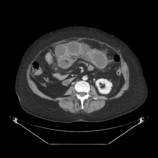 Closed loop small bowel obstruction - internal hernia (Radiopaedia 65402-74450 A 66).jpg