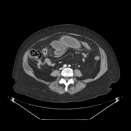 File:Closed loop small bowel obstruction - internal hernia (Radiopaedia 65402-74450 A 77).jpg