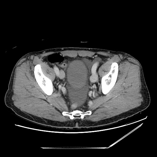 Closed loop small bowel obstruction - omental adhesion causing "internal hernia" (Radiopaedia 85129-100682 A 144).jpg