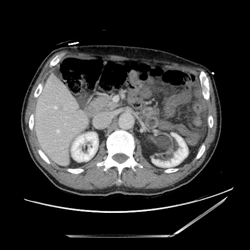 Closed loop small bowel obstruction - omental adhesion causing "internal hernia" (Radiopaedia 85129-100682 A 55).jpg