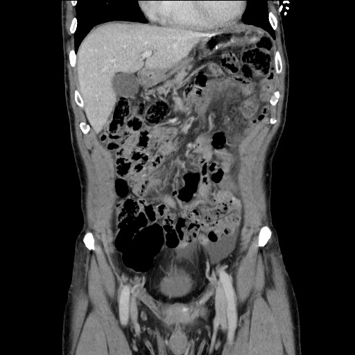Closed loop small bowel obstruction - omental adhesion causing "internal hernia" (Radiopaedia 85129-100682 B 45).jpg