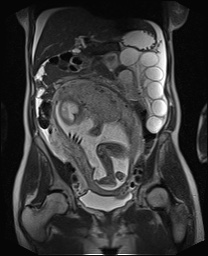 File:Closed loop small bowel obstruction in pregnancy (MRI) (Radiopaedia 87637-104031 Coronal T2 29).jpg