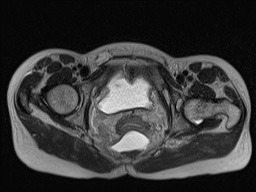 Closed loop small bowel obstruction in pregnancy (MRI) (Radiopaedia 87637-104031 D 38).jpg