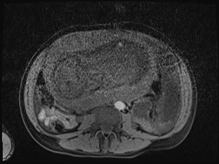Closed loop small bowel obstruction in pregnancy (MRI) (Radiopaedia 87637-104031 F 7).jpg