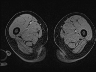 Closed loop small bowel obstruction in pregnancy (MRI) (Radiopaedia 87637-104031 G 57).jpg