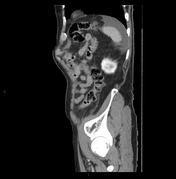 Closed loop small bowel obstruction with ischemia (Radiopaedia 84180-99456 C 76).jpg