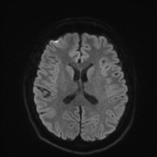 Cochlear incomplete partition type III associated with hypothalamic hamartoma (Radiopaedia 88756-105498 Axial DWI 64).jpg
