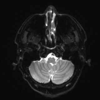 Cochlear incomplete partition type III associated with hypothalamic hamartoma (Radiopaedia 88756-105498 Axial DWI 7).jpg