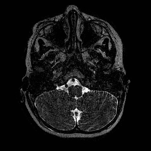File:Cochlear nerve aplasia - unilateral (Radiopaedia 87910-104413 Axial T2 1).jpg