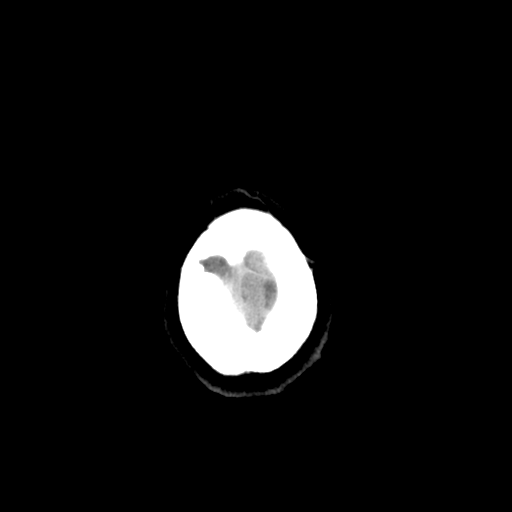 Colloid cyst (large) (Radiopaedia 34415-35734 Axial non-contrast 55).png