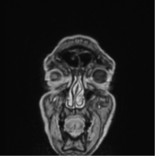 Colloid cyst of the third ventricle (Radiopaedia 86571-102662 Coronal T1 C+ 87).png