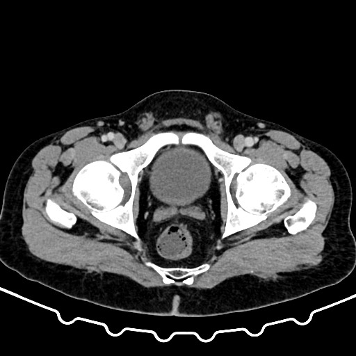 File:Colocolic intussusception due to large lipoma (Radiopaedia 68773-78482 A 185).jpg