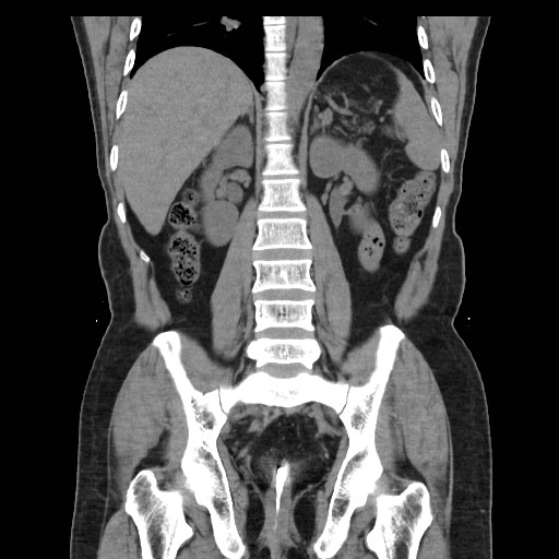 File:Colocutaneous fistula in Crohn's disease (Radiopaedia 29586-30093 E 29).jpg