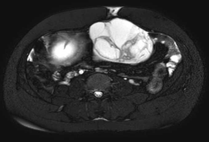 Colon adenocarcinoma with Krukenberg tumors, advanced pregnancy (Radiopaedia 67279-76645 Axial T2 SPAIR 37).jpg
