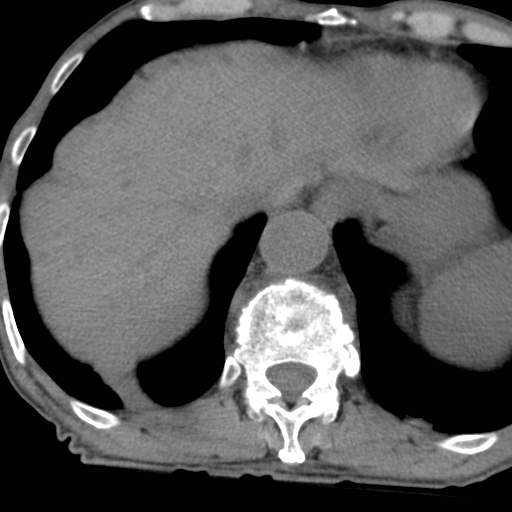 Colon cancer with calcified liver metastasis (Radiopaedia 74423-85309 Axial non-contrast 16).jpg