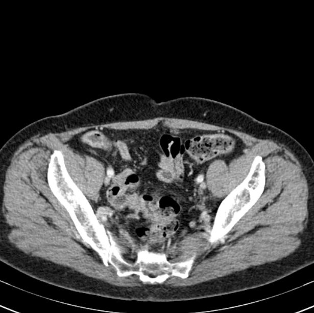 Colon carcinoma with hepatic metastases (Radiopaedia 29477-29961 A 95).jpg