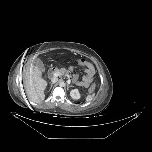 Colonic infarction after colostomy creation (Radiopaedia 81157-94797 A 30).jpg
