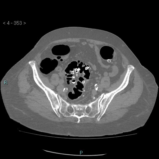Colonic lipomas (Radiopaedia 49137-54244 Axial bone window 157).jpg