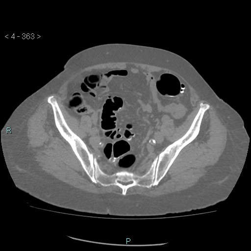 File:Colonic lipomas (Radiopaedia 49137-54244 Axial bone window 161).jpg