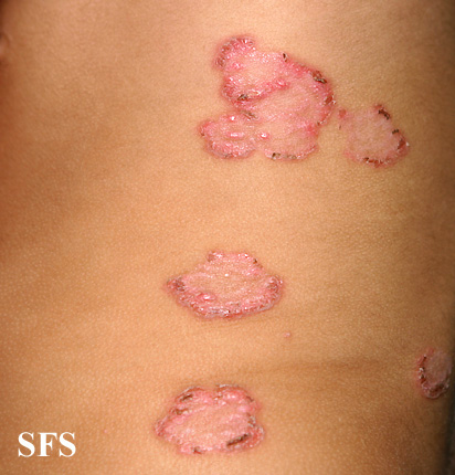 File:Impetigo (Dermatology Atlas 48).jpg