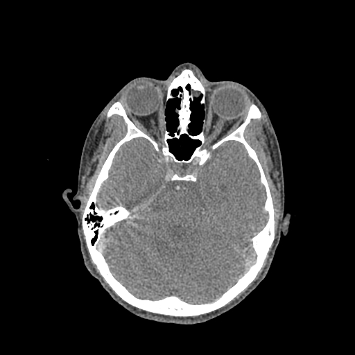 File:Nasal pyogenic granuloma (lobular capillary hemangioma) (Radiopaedia 85536-101244 C 101).jpg